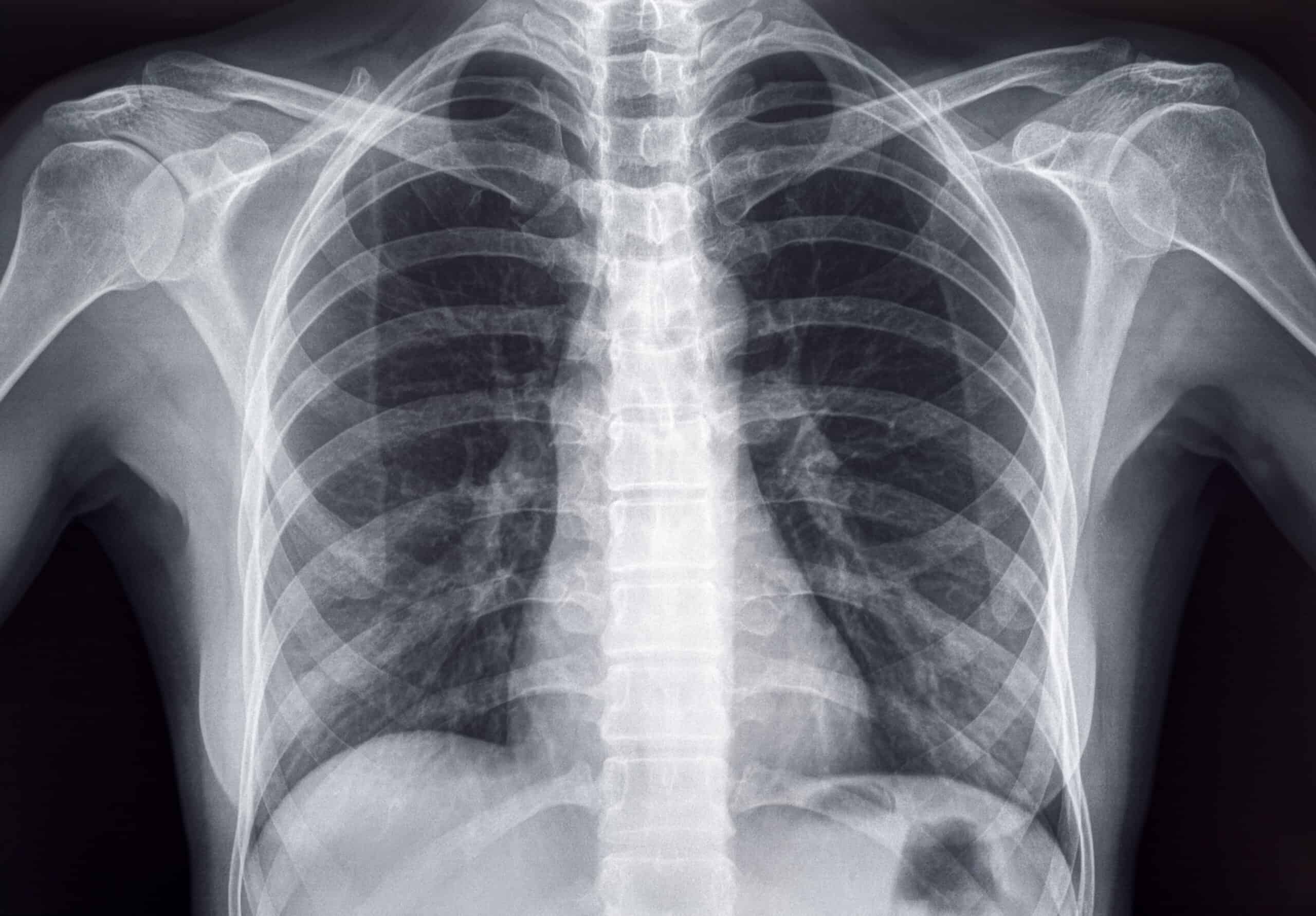 Chest X-ray of an Adult Female Human